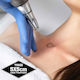 Three Treatments - up to 5cm x 5cm Laser Tattoo Removal - Save $60