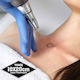Three Treatments - up to 10cm x 20cm Laser Tattoo Removal Treatments
